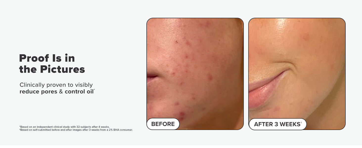 Paula's Choice SKIN PERFECTING 2% BHA Liquid Salicylic Acid Exfoliant-Facial Exfoliant for Blackheads, Enlarged Pores, Wrinkles & Fine Lines 24hrsmart